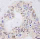 RNF40 / STARING Antibody - Detection of Human RNF40 by Immunohistochemistry. Sample: FFPE section of human mucinous ovarian carcinoma. Antibody: Affinity purified rabbit anti-RNF40 used at a dilution of 1:250. Detection: DAB staining using anti-Rabbit IHC antibody at a dilution of 1:100.