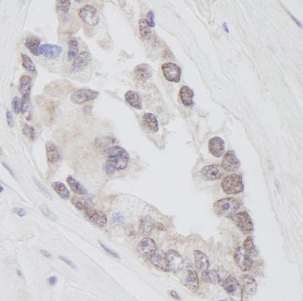 RNF40 / STARING Antibody - Detection of Human RNF40 by Immunohistochemistry. Sample: FFPE section of human prostate adenocarcinoma. Antibody: Affinity purified rabbit anti-RNF40 used at a dilution of 1:250. Detection: DAB staining using anti-Rabbit IHC antibody at a dilution of 1:100.