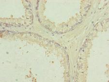 RNF41 Antibody - Immunohistochemistry of paraffin-embedded human prostate cancer at dilution of 1:100