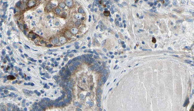 RNF41 Antibody - 1:100 staining human prostate tissue by IHC-P. The sample was formaldehyde fixed and a heat mediated antigen retrieval step in citrate buffer was performed. The sample was then blocked and incubated with the antibody for 1.5 hours at 22°C. An HRP conjugated goat anti-rabbit antibody was used as the secondary.