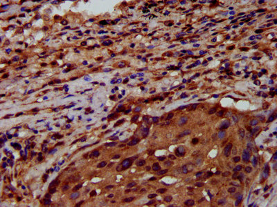 RNF43 Antibody - Immunohistochemistry image at a dilution of 1:600 and staining in paraffin-embedded human lung cancer performed on a Leica BondTM system. After dewaxing and hydration, antigen retrieval was mediated by high pressure in a citrate buffer (pH 6.0) . Section was blocked with 10% normal goat serum 30min at RT. Then primary antibody (1% BSA) was incubated at 4 °C overnight. The primary is detected by a biotinylated secondary antibody and visualized using an HRP conjugated SP system.