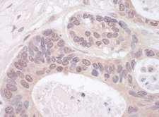 RNGTT / HCAP Antibody - Detection of Human RNGTT by Immunohistochemistry. Sample: FFPE section of human ovarian carcinoma. Antibody: Affinity purified rabbit anti-RNGTT used at a dilution of 1:200 (1 ug/ml). Detection: Vector Laboratories ImmPACT NovaRED Peroxidase Substrate.