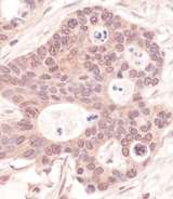 RNGTT / HCAP Antibody - Detection of Human RNGTT by Immunohistochemistry. Sample: FFPE section of human ovarian carcinoma. Antibody: Affinity purified rabbit anti-RNGTT used at a dilution of 1:200 (1 ug/ml). Detection: Vector Laboratories ImmPACT NovaRED Peroxidase Substrate.
