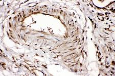 RNH1 Antibody - IHC analysis of RNH1 using anti-RNH1 antibody. RNH1 was detected in paraffin-embedded section of human intestinal cancer tissues. Heat mediated antigen retrieval was performed in citrate buffer (pH6, epitope retrieval solution) for 20 mins. The tissue section was blocked with 10% goat serum. The tissue section was then incubated with 1µg/ml rabbit anti-RNH1 Antibody overnight at 4°C. Biotinylated goat anti-rabbit IgG was used as secondary antibody and incubated for 30 minutes at 37°C. The tissue section was developed using Strepavidin-Biotin-Complex (SABC) with DAB as the chromogen.