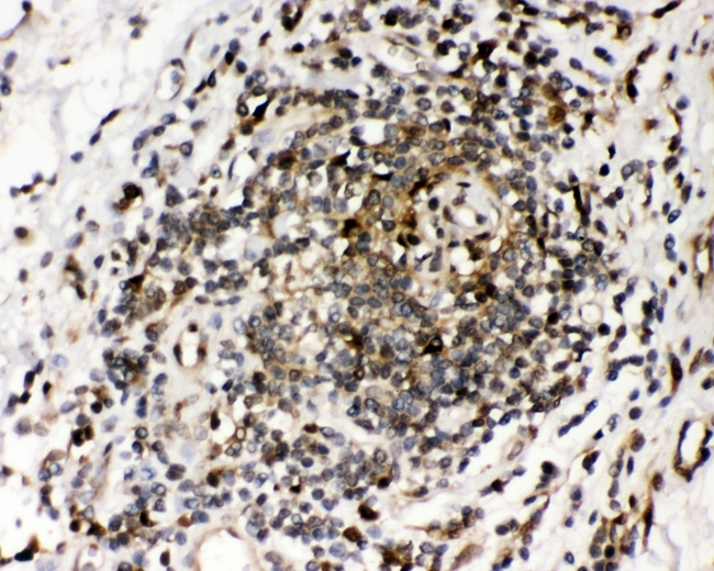 RNH1 Antibody - IHC analysis of RNH1 using anti-RNH1 antibody. RNH1 was detected in paraffin-embedded section of human intestinal cancer tissues. Heat mediated antigen retrieval was performed in citrate buffer (pH6, epitope retrieval solution) for 20 mins. The tissue section was blocked with 10% goat serum. The tissue section was then incubated with 1µg/ml rabbit anti-RNH1 Antibody overnight at 4°C. Biotinylated goat anti-rabbit IgG was used as secondary antibody and incubated for 30 minutes at 37°C. The tissue section was developed using Strepavidin-Biotin-Complex (SABC) with DAB as the chromogen.