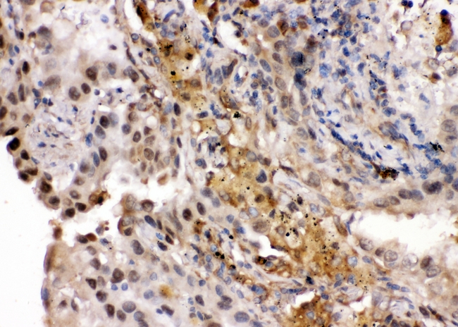 RNH1 Antibody - IHC analysis of RNH1 using anti-RNH1 antibody. RNH1 was detected in paraffin-embedded section of human lung cancer tissues. Heat mediated antigen retrieval was performed in citrate buffer (pH6, epitope retrieval solution) for 20 mins. The tissue section was blocked with 10% goat serum. The tissue section was then incubated with 1µg/ml rabbit anti-RNH1 Antibody overnight at 4°C. Biotinylated goat anti-rabbit IgG was used as secondary antibody and incubated for 30 minutes at 37°C. The tissue section was developed using Strepavidin-Biotin-Complex (SABC) with DAB as the chromogen.