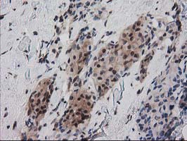 RNH1 Antibody - IHC of paraffin-embedded Adenocarcinoma of Human breast tissue using anti-RNH1 mouse monoclonal antibody.