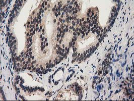 RNH1 Antibody - IHC of paraffin-embedded Carcinoma of Human prostate tissue using anti-RNH1 mouse monoclonal antibody.