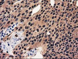 RNH1 Antibody - IHC of paraffin-embedded Carcinoma of Human bladder tissue using anti-RNH1 mouse monoclonal antibody.