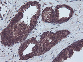 RNH1 Antibody - IHC of paraffin-embedded Carcinoma of Human prostate tissue using anti-RNH1 mouse monoclonal antibody.