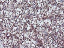 RNH1 Antibody - IHC of paraffin-embedded Carcinoma of Human kidney tissue using anti-RNH1 mouse monoclonal antibody.