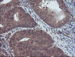 RNH1 Antibody - IHC of paraffin-embedded Adenocarcinoma of Human endometrium tissue using anti-RNH1 mouse monoclonal antibody.