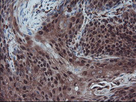 RNH1 Antibody - IHC of paraffin-embedded Carcinoma of Human bladder tissue using anti-RNH1 mouse monoclonal antibody.