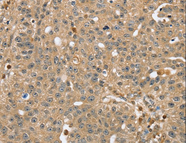 RNH1 Antibody - Immunohistochemistry of paraffin-embedded Human breast cancer using RNH1 Polyclonal Antibody at dilution of 1:40.
