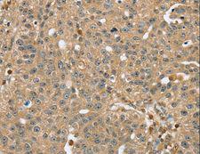 RNH1 Antibody - Immunohistochemistry of paraffin-embedded Human breast cancer using RNH1 Polyclonal Antibody at dilution of 1:40.