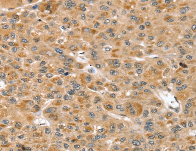 RNH1 Antibody - Immunohistochemistry of paraffin-embedded Human liver cancer using RNH1 Polyclonal Antibody at dilution of 1:30.