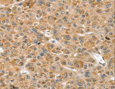 RNH1 Antibody - Immunohistochemistry of paraffin-embedded Human liver cancer using RNH1 Polyclonal Antibody at dilution of 1:30.