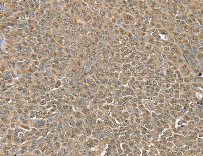 RNH1 Antibody - Immunohistochemistry of paraffin-embedded Human ovarian cancer using RNH1 Polyclonal Antibody at dilution of 1:30.
