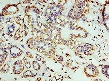 RNLS / Renalase Antibody - Immunohistochemistry of paraffin-embedded human breast cancer using antibody at 1:100 dilution.