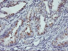 RNPEP Antibody - IHC of paraffin-embedded Adenocarcinoma of Human endometrium tissue using anti-RNPEP mouse monoclonal antibody.