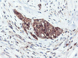 RNPEP Antibody - IHC of paraffin-embedded Adenocarcinoma of Human breast tissue using anti-RNPEP mouse monoclonal antibody.