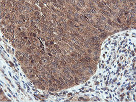 RNPEP Antibody - IHC of paraffin-embedded Carcinoma of Human bladder tissue using anti-RNPEP mouse monoclonal antibody.