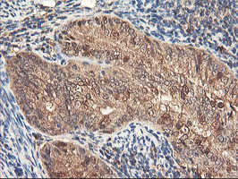 RNPEP Antibody - IHC of paraffin-embedded Adenocarcinoma of Human endometrium tissue using anti-RNPEP mouse monoclonal antibody. (Heat-induced epitope retrieval by 10mM citric buffer, pH6.0, 100C for 10min).