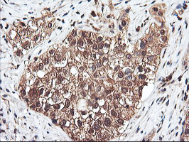 RNPEP Antibody - IHC of paraffin-embedded Carcinoma of Human bladder tissue using anti-RNPEP mouse monoclonal antibody. (Heat-induced epitope retrieval by 10mM citric buffer, pH6.0, 100C for 10min).
