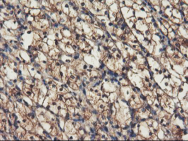 RNPEP Antibody - IHC of paraffin-embedded Carcinoma of Human kidney tissue using anti-RNPEP mouse monoclonal antibody. (Heat-induced epitope retrieval by 10mM citric buffer, pH6.0, 100C for 10min).