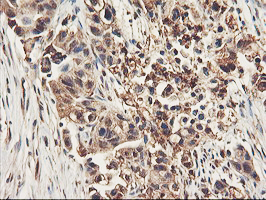 RNPEP Antibody - IHC of paraffin-embedded Carcinoma of Human lung tissue using anti-RNPEP mouse monoclonal antibody. (Heat-induced epitope retrieval by 10mM citric buffer, pH6.0, 100C for 10min).