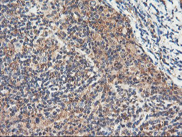 RNPEP Antibody - IHC of paraffin-embedded Human lymphoma tissue using anti-RNPEP mouse monoclonal antibody. (Heat-induced epitope retrieval by 10mM citric buffer, pH6.0, 100C for 10min).