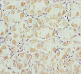 ROBO3 Antibody - Immunohistochemistry of paraffin-embedded human gastric cancer at dilution 1:100