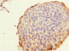 ROBO4 Antibody - Immunohistochemistry of paraffin-embedded human bladder cancer at dilution 1:100