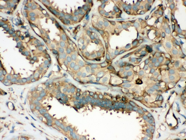 ROCK2 Antibody - ROCK2 antibody IHC-paraffin: Human Mammary Cancer Tissue.