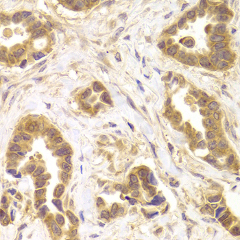 ROCK2 Antibody - Immunohistochemistry of paraffin-embedded human mammary cancer tissue.