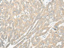 ROM1 Antibody - Immunohistochemistry of paraffin-embedded Human liver cancer tissue  using ROM1 Polyclonal Antibody at dilution of 1:25(×200)
