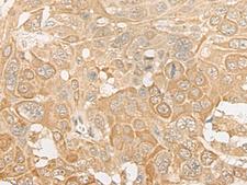 ROM1 Antibody - Immunohistochemistry of paraffin-embedded Human esophagus cancer tissue  using ROM1 Polyclonal Antibody at dilution of 1:30(×200)
