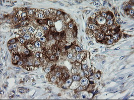 ROMO1 Antibody - IHC of paraffin-embedded Adenocarcinoma of Human breast tissue using anti-ROMO1 mouse monoclonal antibody. (Heat-induced epitope retrieval by 10mM citric buffer, pH6.0, 120°C for 3min).