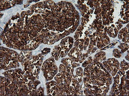 ROMO1 Antibody - IHC of paraffin-embedded Carcinoma of Human thyroid tissue using anti-ROMO1 mouse monoclonal antibody. (Heat-induced epitope retrieval by 10mM citric buffer, pH6.0, 120°C for 3min).