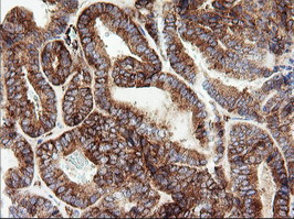 ROMO1 Antibody - IHC of paraffin-embedded Adenocarcinoma of Human endometrium tissue using anti-ROMO1 mouse monoclonal antibody. (Heat-induced epitope retrieval by 10mM citric buffer, pH6.0, 120°C for 3min).