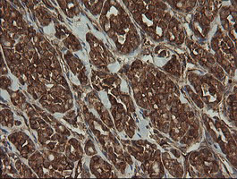 ROMO1 Antibody - IHC of paraffin-embedded Carcinoma of Human thyroid tissue using anti-ROMO1 mouse monoclonal antibody. (Heat-induced epitope retrieval by 10mM citric buffer, pH6.0, 100C for 10min).