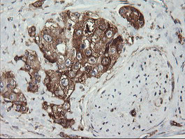 ROMO1 Antibody - IHC of paraffin-embedded Adenocarcinoma of Human breast tissue using anti-ROMO1 mouse monoclonal antibody. (Heat-induced epitope retrieval by 10mM citric buffer, pH6.0, 100C for 10min).