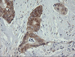 ROMO1 Antibody - IHC of paraffin-embedded Adenocarcinoma of Human colon tissue using anti-ROMO1 mouse monoclonal antibody. (Heat-induced epitope retrieval by 10mM citric buffer, pH6.0, 100C for 10min).