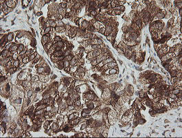 ROMO1 Antibody - IHC of paraffin-embedded Adenocarcinoma of Human ovary tissue using anti-ROMO1 mouse monoclonal antibody. (Heat-induced epitope retrieval by 10mM citric buffer, pH6.0, 100C for 10min).
