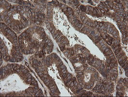 ROMO1 Antibody - IHC of paraffin-embedded Adenocarcinoma of Human endometrium tissue using anti-ROMO1 mouse monoclonal antibody. (Heat-induced epitope retrieval by 10mM citric buffer, pH6.0, 100C for 10min).