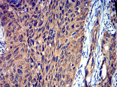 ROP1 Antibody - Immunohistochemical analysis of paraffin-embedded ROP1 tissues using cervical cancer mouse mAb with DAB staining.