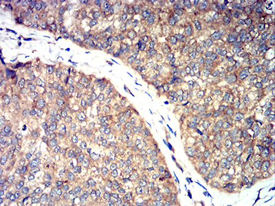 ROP1 Antibody - Immunohistochemical analysis of paraffin-embedded ROP1 tissues using bladder cancer mouse mAb with DAB staining.