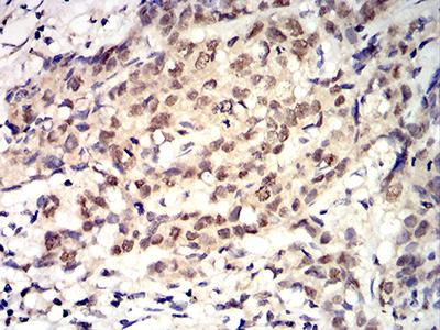 ROP1 Antibody - Immunohistochemical analysis of paraffin-embedded breast cancer tissues using ROP1 mouse mAb with DAB staining.