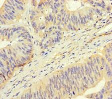 ROPN1 / Ropporin Antibody - Immunohistochemistry of paraffin-embedded human colon cancer using ROPN1 Antibody at dilution of 1:100