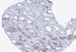 ROPN1L Antibody - IHC of ASP in human pancreatic tumor tissue using Polyclonal Antibody to AKAP-associated sperm protein (ASP) at 1:100 dilution.